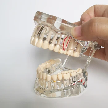 Nova Dental Modelo Dentes Restauração De Implantes De Ponte De Ensino Estudo De Dente De Ciências Médicas De Doença Dentista Odontologia Produtos
